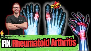 Rheumatoid Arthritis [Symptoms, Early Signs, Stages & BEST Treatment]