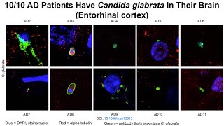 Fungi In The Blood, Fungi In The Brain: Rapamycin To The Rescue?