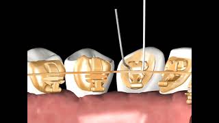 Incognito™ Appliance System Clinical Guide 04: Reverse Double Overtie with Steel Ligature