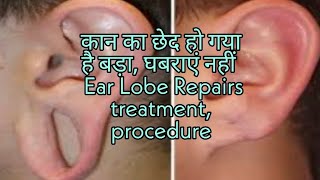 Ear Lobe Repairs treatment,procedure  To Shrink Drooping Earlobes Naturally.facts and me in hindi