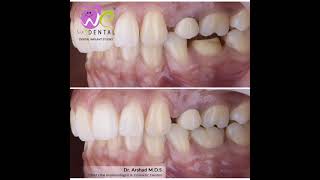 Zirconia| Crown| We Dental| Best Dental| Dr Arshad| Molar esthetics| All ceramic| Backtooth esthetic