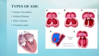 Atrial Septal Defect (ASD)