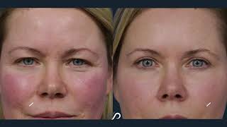 Traceless Facelift On A 47-year-old Female | Before and After | Dr. David Stoker