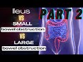 GENERAL SURGERY: Small bowel obstruction vs Large bowel obstruction vs Ileus