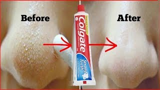 Colgate से Blackheads करे गायब जैसे कभी थे ही नहीं - 5 Minutes Treatment - How to Remove Blackheads