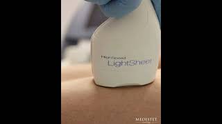 Лазерная эпиляция аппаратом Lumenis LightSheer. Косметология Медэстет Винница