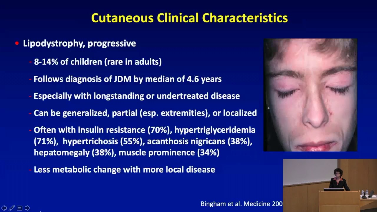 Skin Disease And Juvenile Dermatomyositis - YouTube