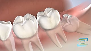 Wisdom Teeth Removal at Fresno Oral Maxillofacial Surgery \u0026 Dental Implant Center