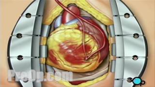Coronary Artery Bypass Graft (CABG off-pump) Heart Surgery PreOp® Patient Education