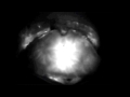 Fluorescence Imaging during Breast Reconstructive Surgery (DIEP)