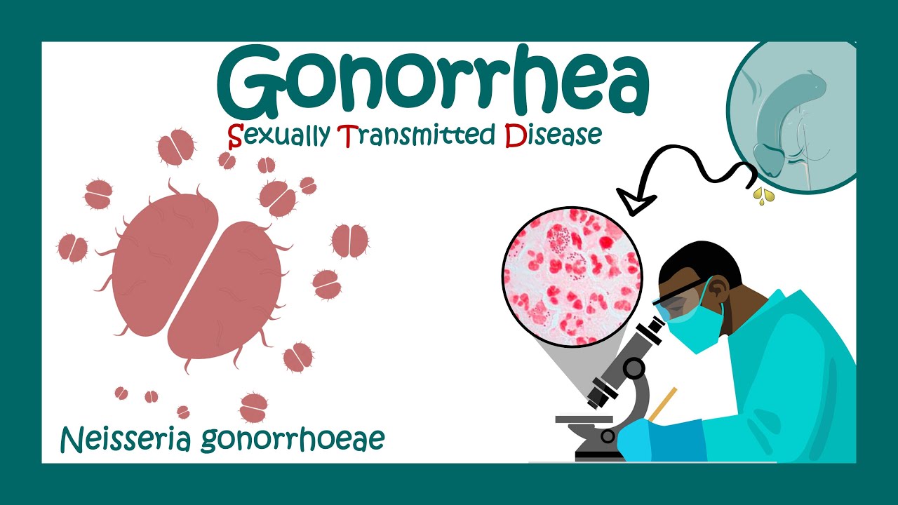 Gonorrhea: Signs, Symptoms, And Complications, 60% OFF