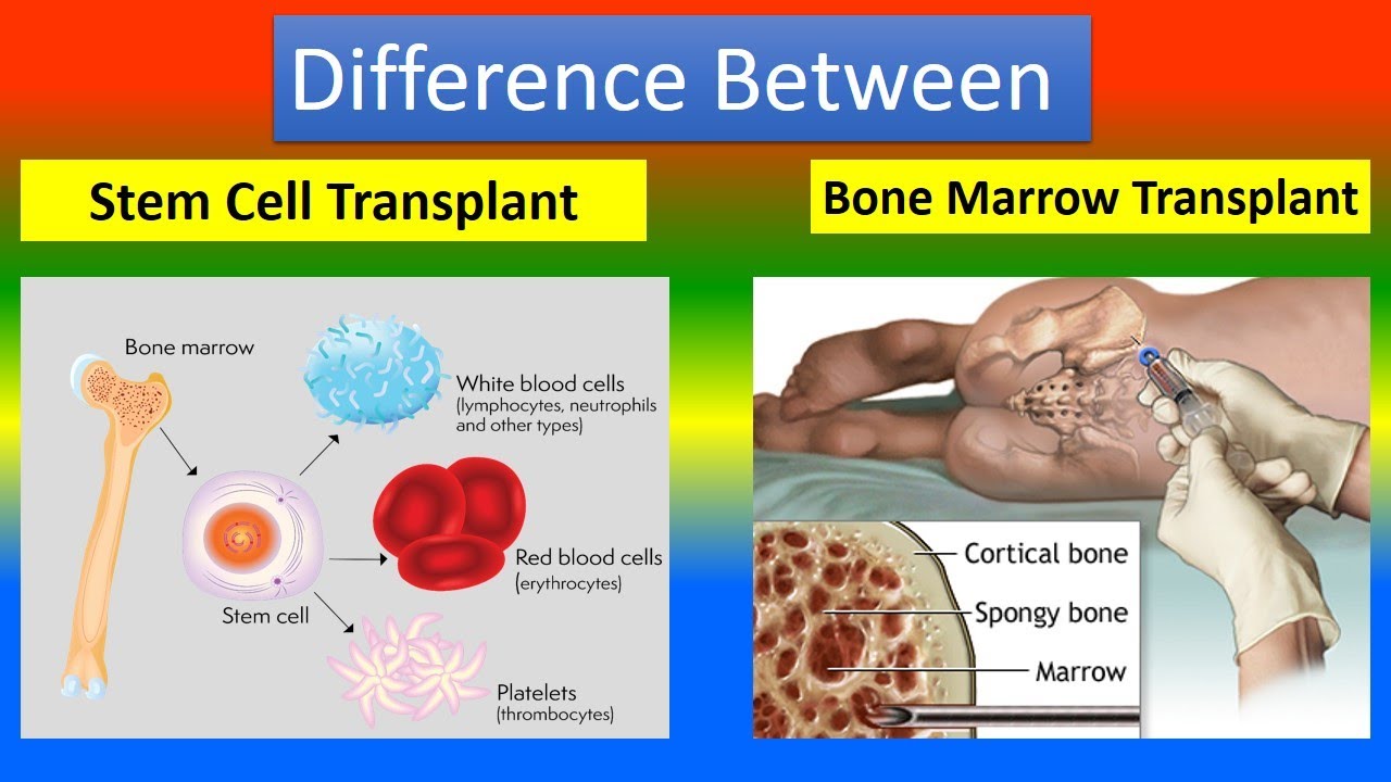 Difference Between Stem Cell Transplant And Bone Marrow Transplant ...