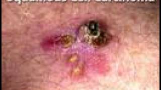 Understanding Squamous Cell Carcinoma (Skin Cancer #5)