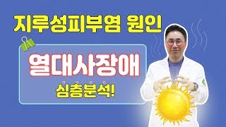 열대사 장애를 모르세요??? 지루성피부염의 원인은 열대사장애입니다.