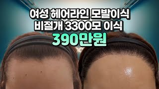 모발이식비용 여성헤어라인 교정 비절개모발이식 3300모 390만원 #모발이식#모발이식비용#헤어라인모발이식