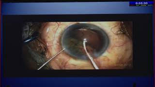 AIOC2020 GP098 T6  Dr K A Salvin Difficult Cataract Surgeries from Retinal Surgeons point of view