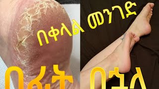 በ 6 ቀላል ነገሮች ከእግር መሠነጣጠቅ መዳን|የእግር እንክብካቤ| Lamina