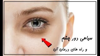 برطرف کردن سیاهی دورچشم سریع در خانه