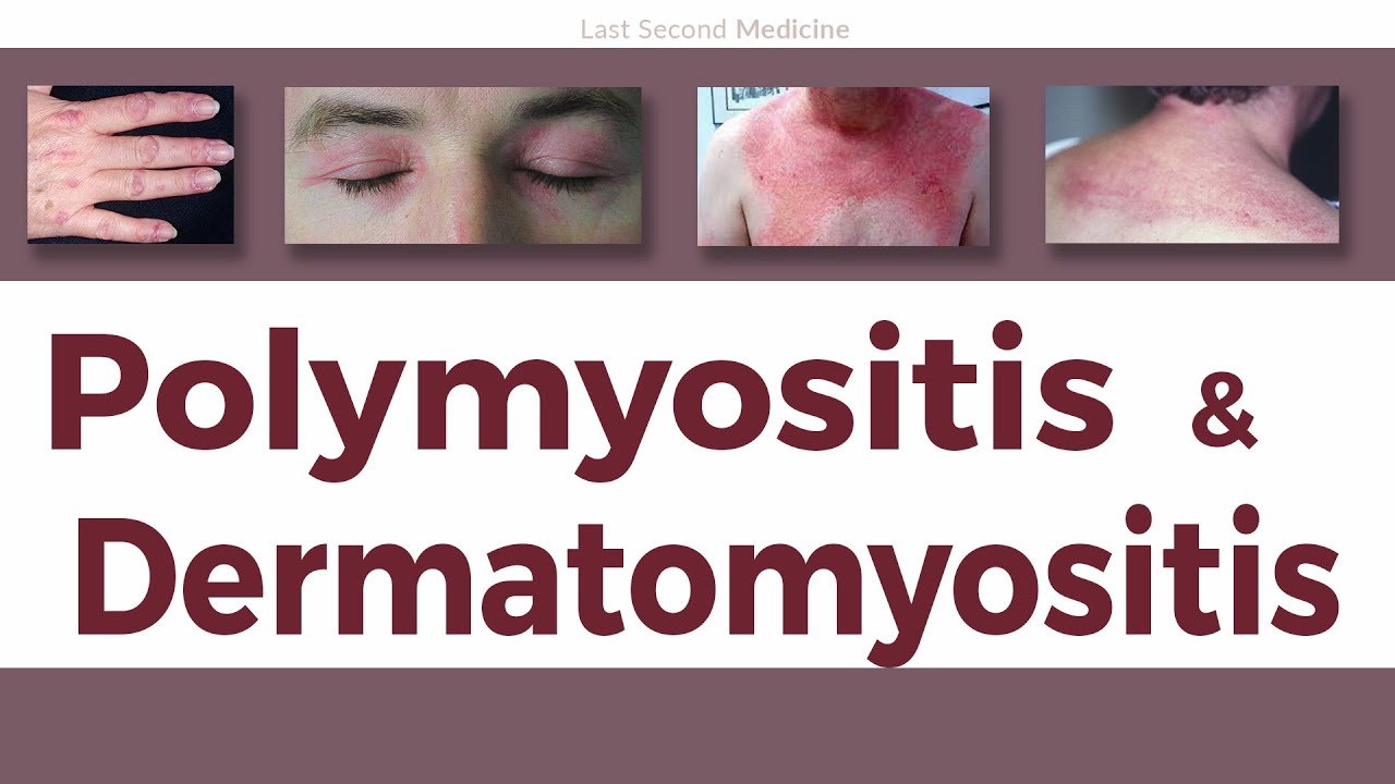 A Simplified Overview Of Polymyositis & Dermatomyositis - Clinical ...