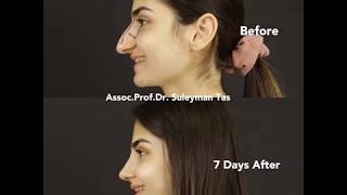90° TAS Video | Before & 7 Days After Closed Rhinoplasty