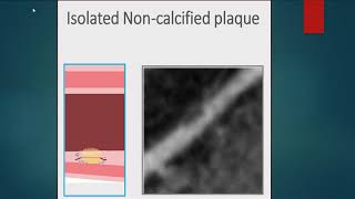 Atherosclerotic Plaque Definition using Cardiac CT Angiography