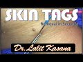 SKIN TAG REMOVAL IN SECONDS  by DR.LALIT KASANA