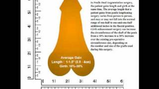 Penile Dual Augmentation Surgery (Part 3 of 4)