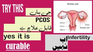 PCOS treatment||how to cure pcos||tips to treat poly cystic ovary syndrome||exercises to reduce pcos