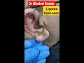 ear cyst shorts cystremoval skincare pimplepopper dr khaled sadek lipomacyst.com