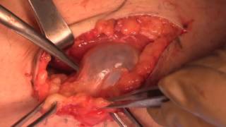 Popliteal Cyst Excision