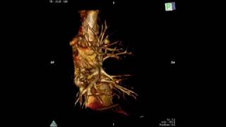 Subxiphoid  biportal VATS Right S1 S2 Bisegmentectomy