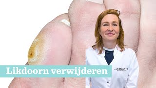 Likdoorn (eksteroog) verwijderen: Hoe doe je dat?