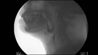 Modified Barium Swallow Study - Michael Groher | MedBridge