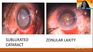 AIOC2021-GP95-Topic-Dr.Jayashree Baruah-Perfecting a good  Capsulorhexis