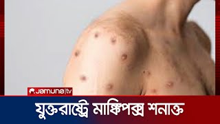 প্রথমবারের মতো যুক্তরাষ্ট্রে মাঙ্কিপক্স সংক্রমিত শনাক্ত | US Monkeypox