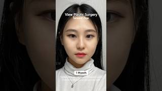 รีวิวศัลยกรรมเกาหลี ปรับโครงหน้า💖  #plasticsurgerykorea #ศัลยกรรมเกาหลี #viewplasticsurgeryรีวิว