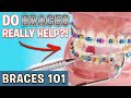 BRACES 101: Can Braces Fix My Teeth?! | Treatment Minute Talk!