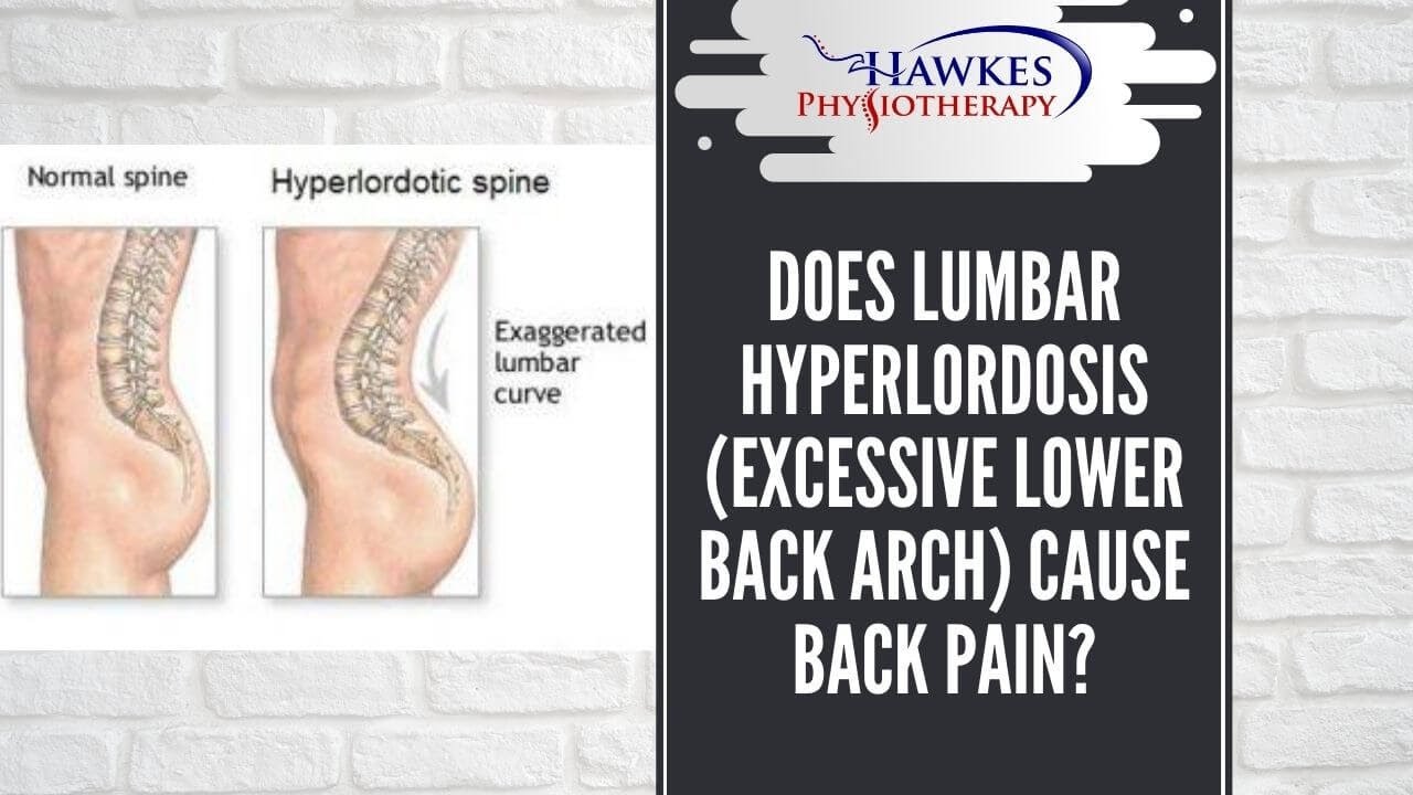 Does Lumbar Hyperlordosis (excessive Lower Back Arch) Cause Back Pain ...