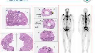 2018年6月攝護腺癌病友會--「攝護腺癌的荷爾蒙治療」(陳正哲醫師)