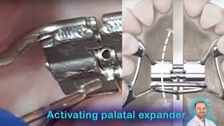 Activating Hyrax expander, expanding the fixed palatal expander by expander key, turn the expander