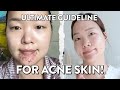 Best skincare for acne skin? Do acne spot treatments really work? Ultimate Guideline for acne skin!