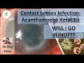 Contact Lenses Related Acanthamoeba Keratitis: Will I Go BLIND? I Dr Shaz Rehan, 2023