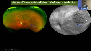 AIOC2022 IC37 Topic Dr  SUNIL GANEKAL Ultra wide field and multimodal Imaging in pathological myopia