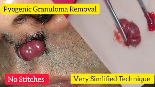 Pyogenic Granuloma Removal - Dr. Anuj Pall MD, PhD, FISD (USA)