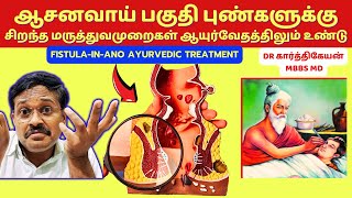 ஆசனவாய் புண் குணமாக | Fistula treatment in India