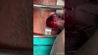 Pus/ Abscess Aspiration from inside the throat || Retropharyngeal abscess #shorts #pus #shortsvideo