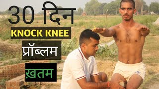 केवल 15 दिन मे फर्क || knock knee kaise thik kare | Top 3 Exercise in hindi | jd physical academy ||