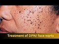 Treatment of DPN/ face warts | By Dr. Uttam Kumar Lenka MBBS, MD (Consultant Dermatologist)