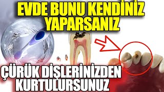 Diş Hekimleri Bunun Bilinmesini İstemez. Çürümeyi Evde Kendiniz Ortadan Kaldırın