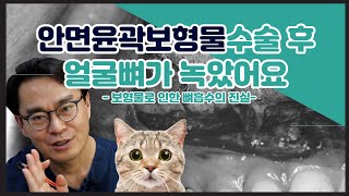 [닥터봉TV_CBK성형외과_최봉균]안면윤곽보형물수술 후 얼굴뼈가 녹았어요 - 보형물로 인한 뼈흡수의 진실[CBK整形外科_チェ·ボンギュン] 顔面輪郭インプラント手術後、顔の骨が溶けました